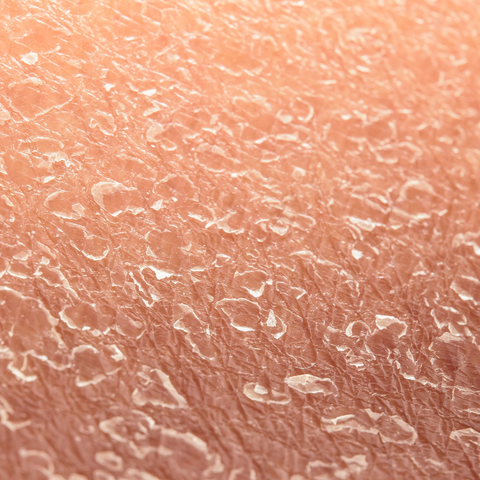 what is the true meaning of dry skin?