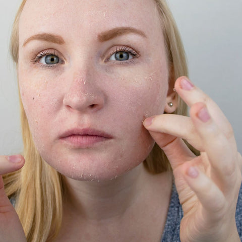 Dry skin can cause breakouts