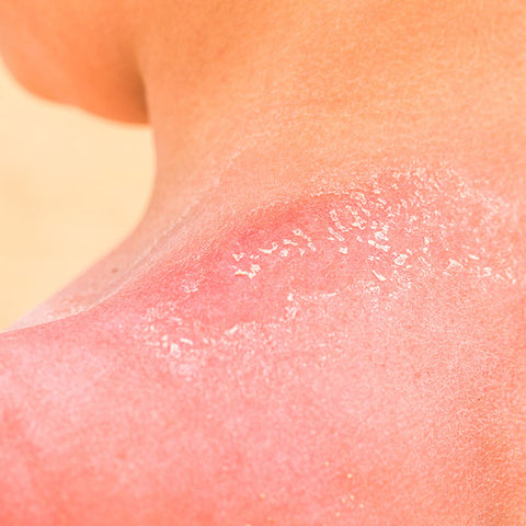 Psoriasis and the sun can cause significant skin damage