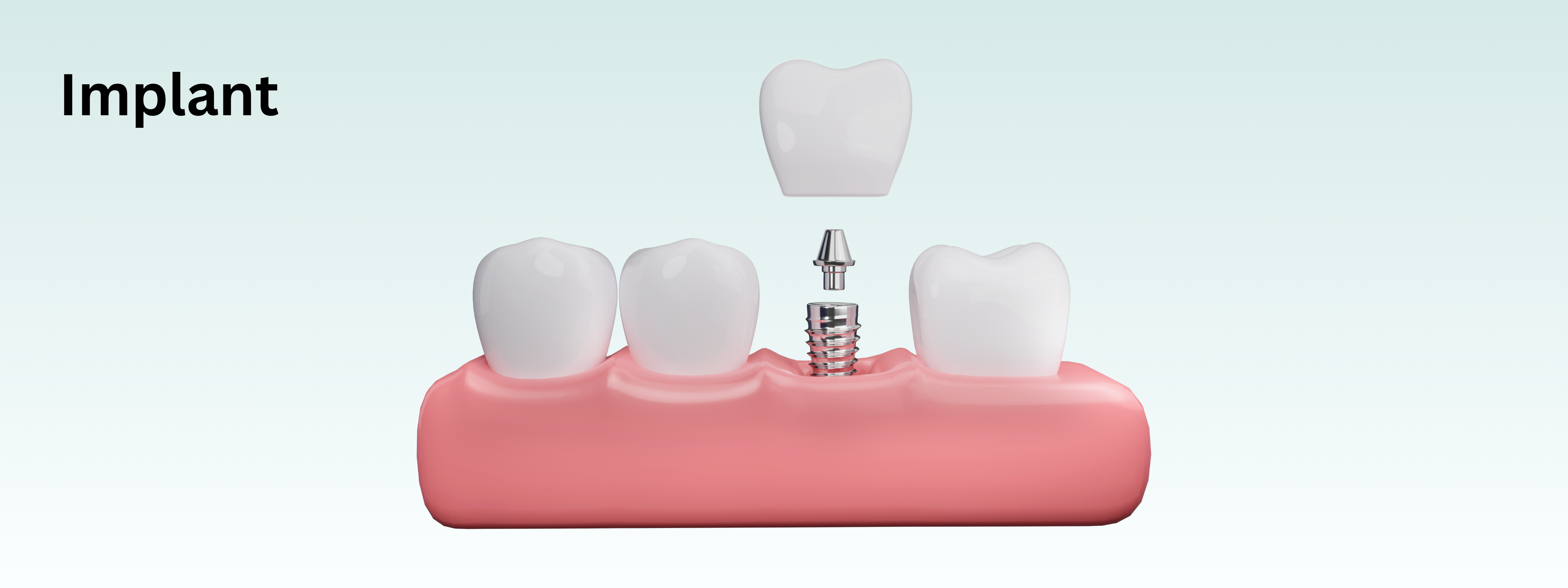 The image shows a dental implant, illustrating the process of placing a titanium post in the jawbone to support a crown or bridge for tooth replacement.