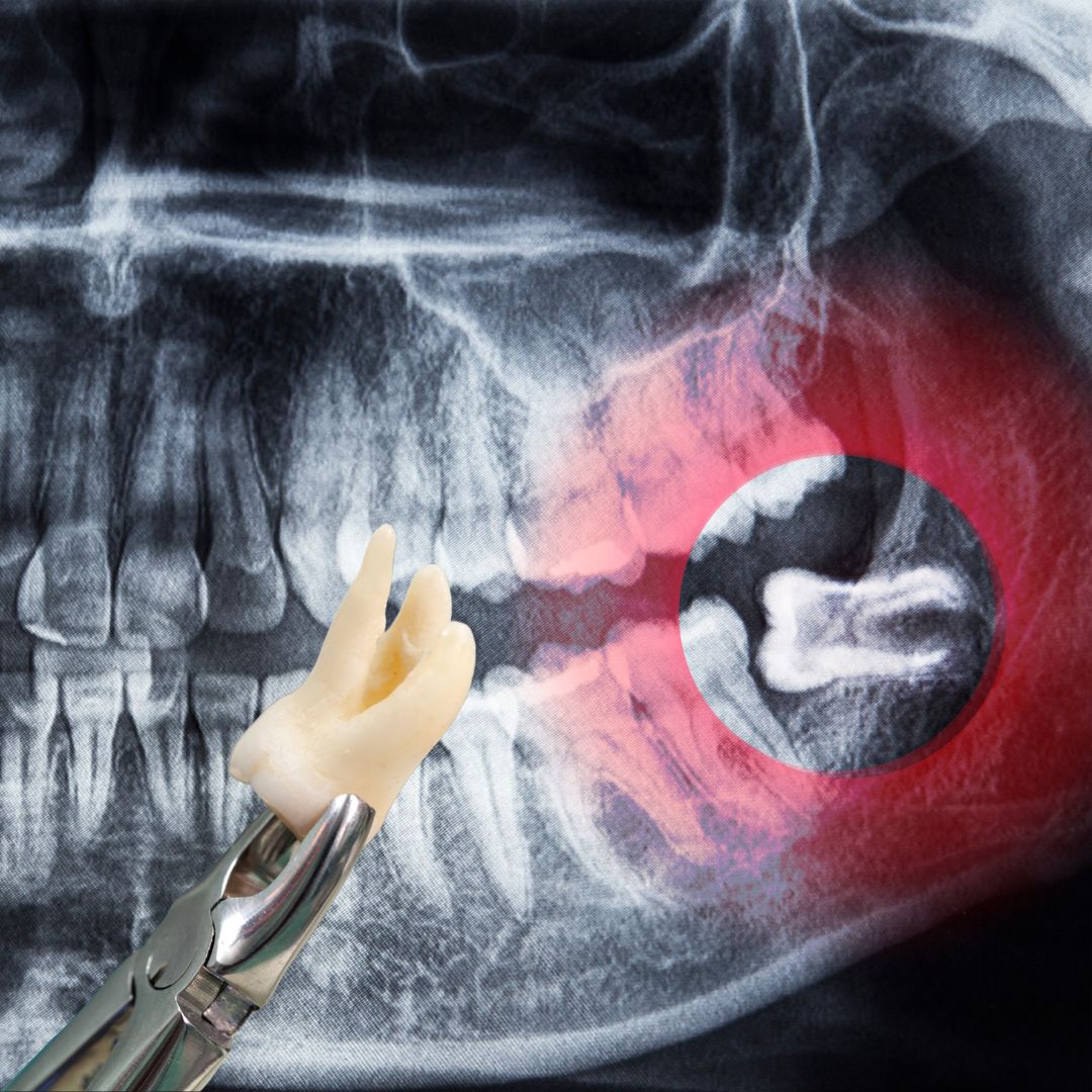 X-ray image of wisdom teeth, highlighting the position and alignment of the teeth within the jaw for diagnostic and treatment planning purposes.