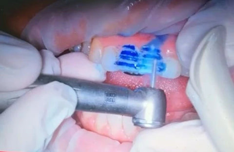 Teeth of a patient that is having a dental procedure is shown on the screen  and the dentist is using a dental bur sold by mr bur the best international dental bur provider