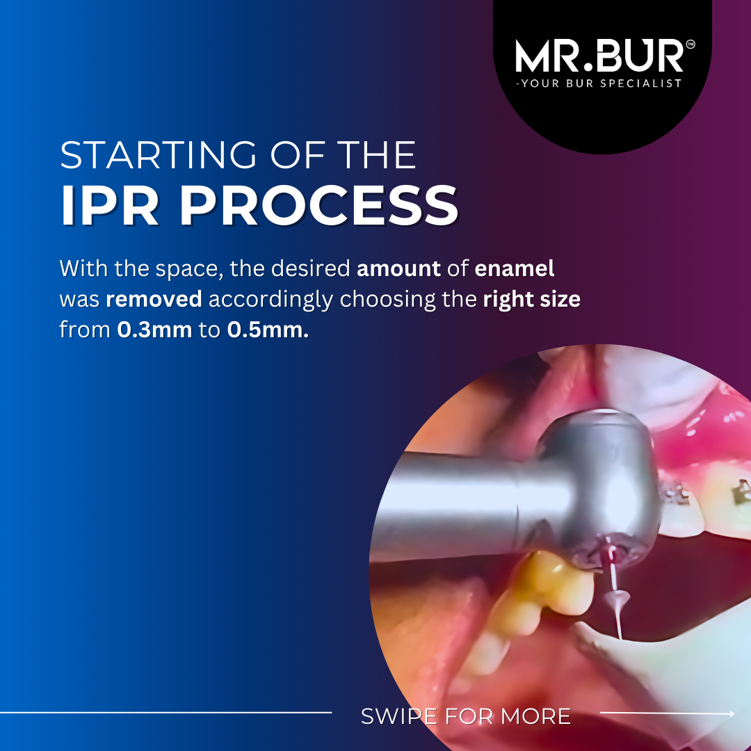 This picture shows the exact and accurate result of Mr Bur IPR bur on removing enamel with the exact size of ipr bur ranging from 0.3mm to 0.5mm