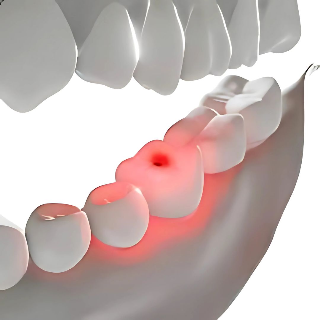 Gambar yang menunjukkan bagaimana sensitivitas gigi dapat diatasi menggunakan Mr. Bur One Slice IPR Kit untuk pengurangan enamel yang tepat dan hasil akhir yang lebih halus.