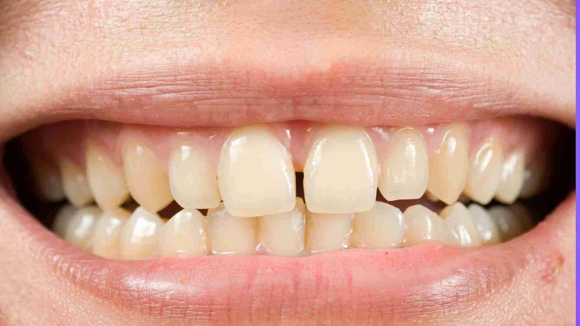 A person having stained teeth