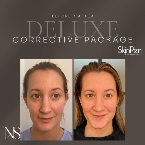 before and after results for skinpen microneedling