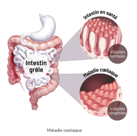 The Serious Gut maladie coeliaque schema