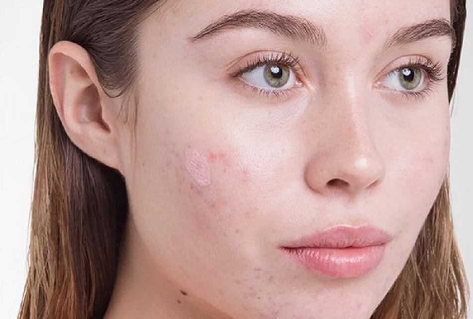 Fights against acne