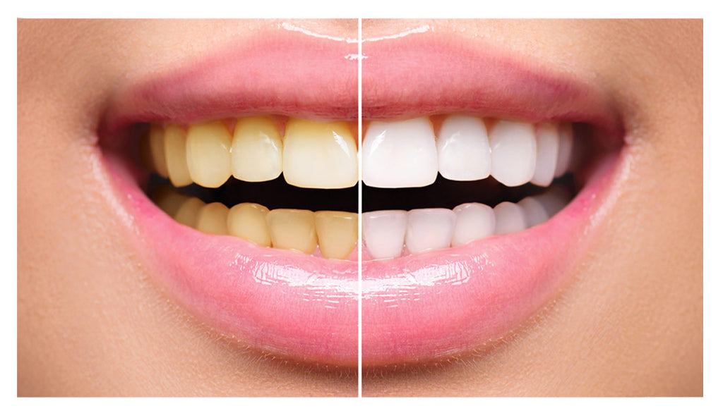 Bild auf der RichSmile-Produktseite zeigt einen Vergleich zwischen gelben und weißen Zähnen. Die linke Hälfte des Bildes zeigt gelbe Zähne, während die rechte Hälfte glänzend weiße Zähne zeigt, erreicht durch die Verwendung von RichSmile Produkten.
