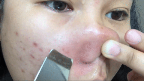 ultrasonic-nose-cleaning