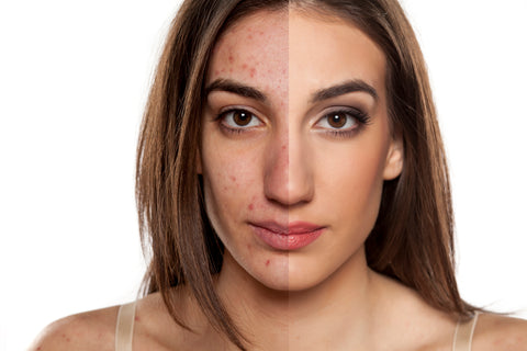 Laser Treatment for Acne