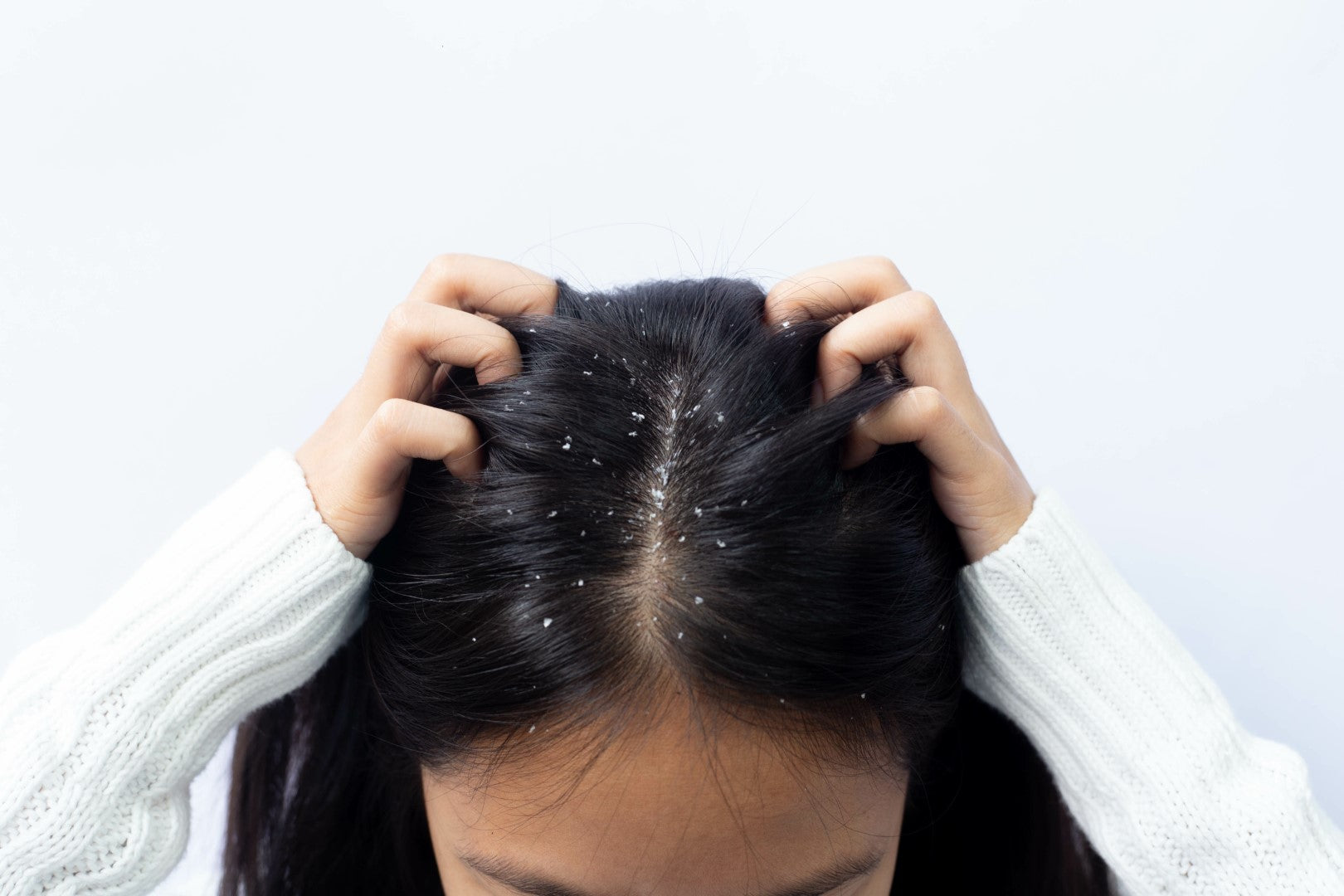How to keep your scalp free from dandruff