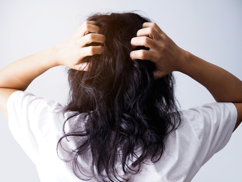  Manage stress levels to stop dandruff.
