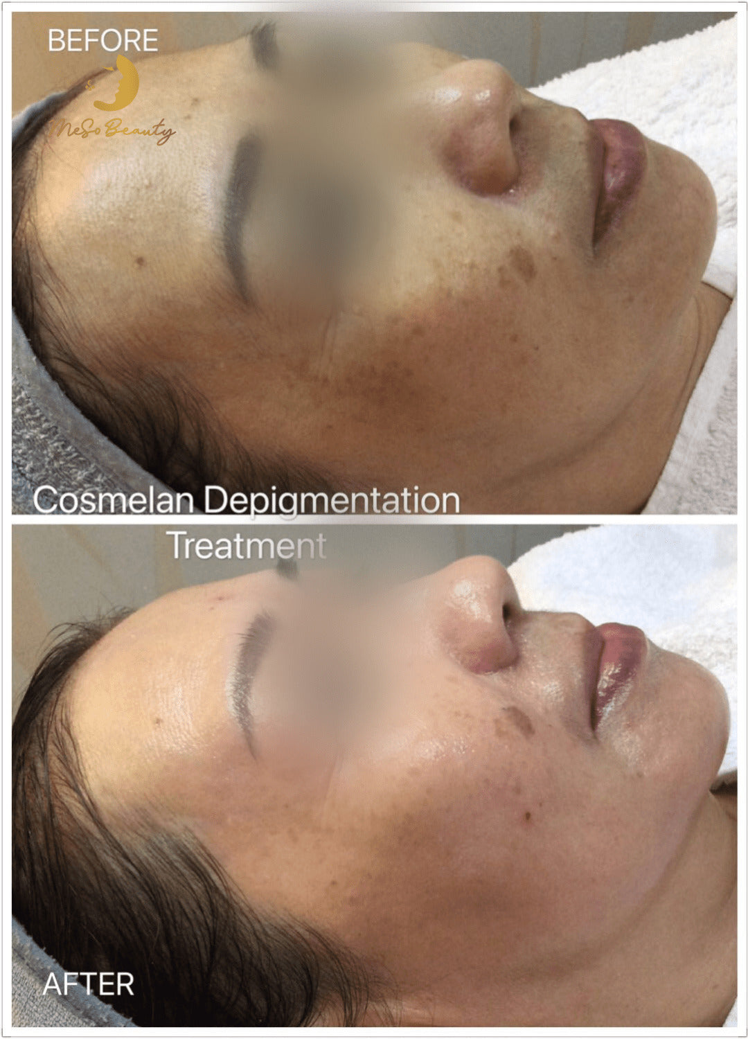 Best Cosmelan Peels in Islamabad, Rawalpindi & Pakistan