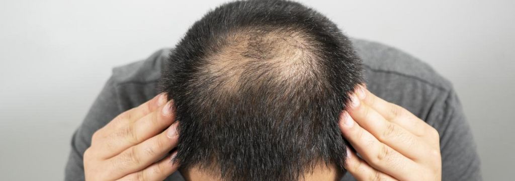 Hair loss due to masturbation