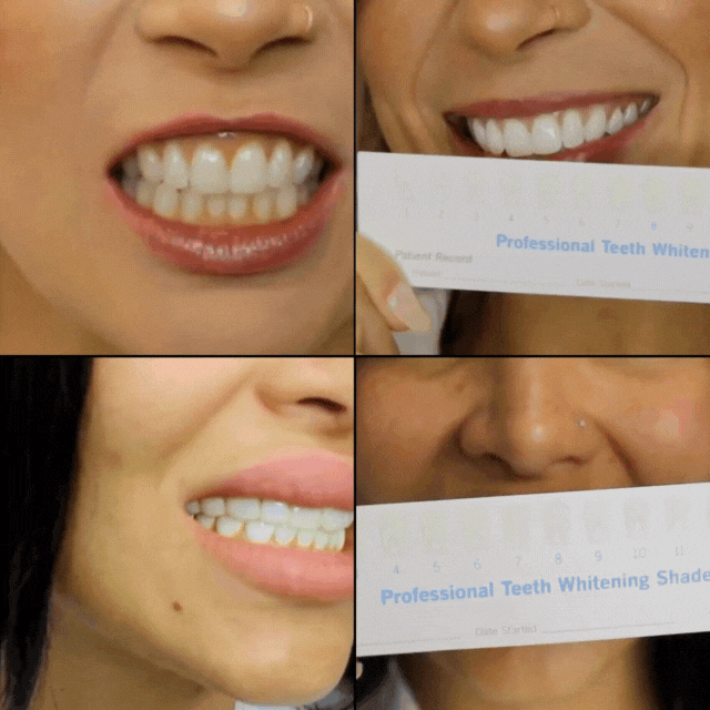 teeth whitening results gif