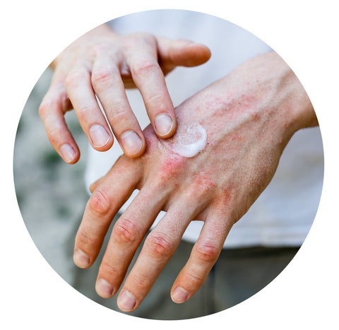 Image of lotion being applied to dry, red hands