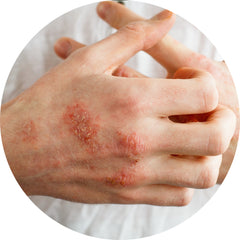 A woman's hands with raised patches of eczema