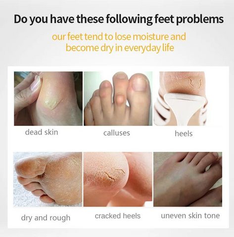 Melt-Away-Roughness-Cushy-Footsie-Relaxing-Foot-Peel-Masks-list-of-feet-problems