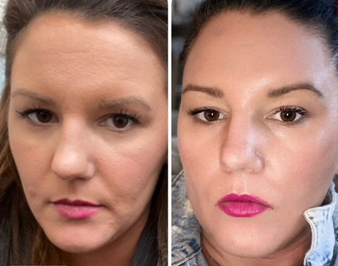 Tretinoin Before and After Photos: How Do You Know it Will Work for Yo –  Dear Brightly