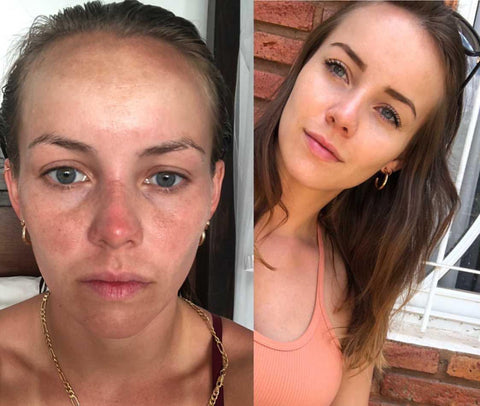 Tretinoin Before and After Photos: How Do You Know it Will Work for Yo –  Dear Brightly