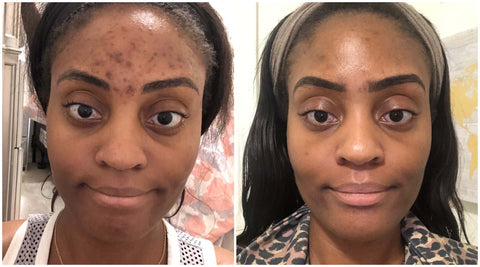 before and after acne, acne scars, uneven skin tone
