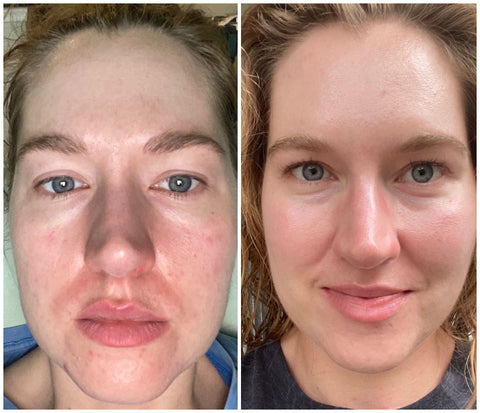 rough skin fine lines acne before and after