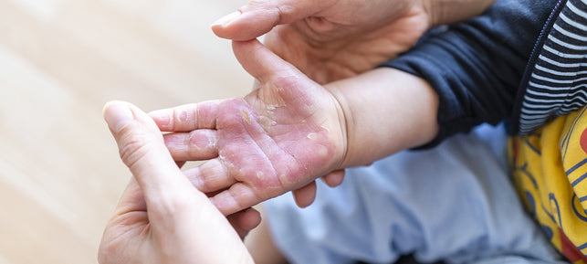 Erwachsene Person hält verbrannte Kinderhand in den eigenen Händen, um sie zu verarzten. 