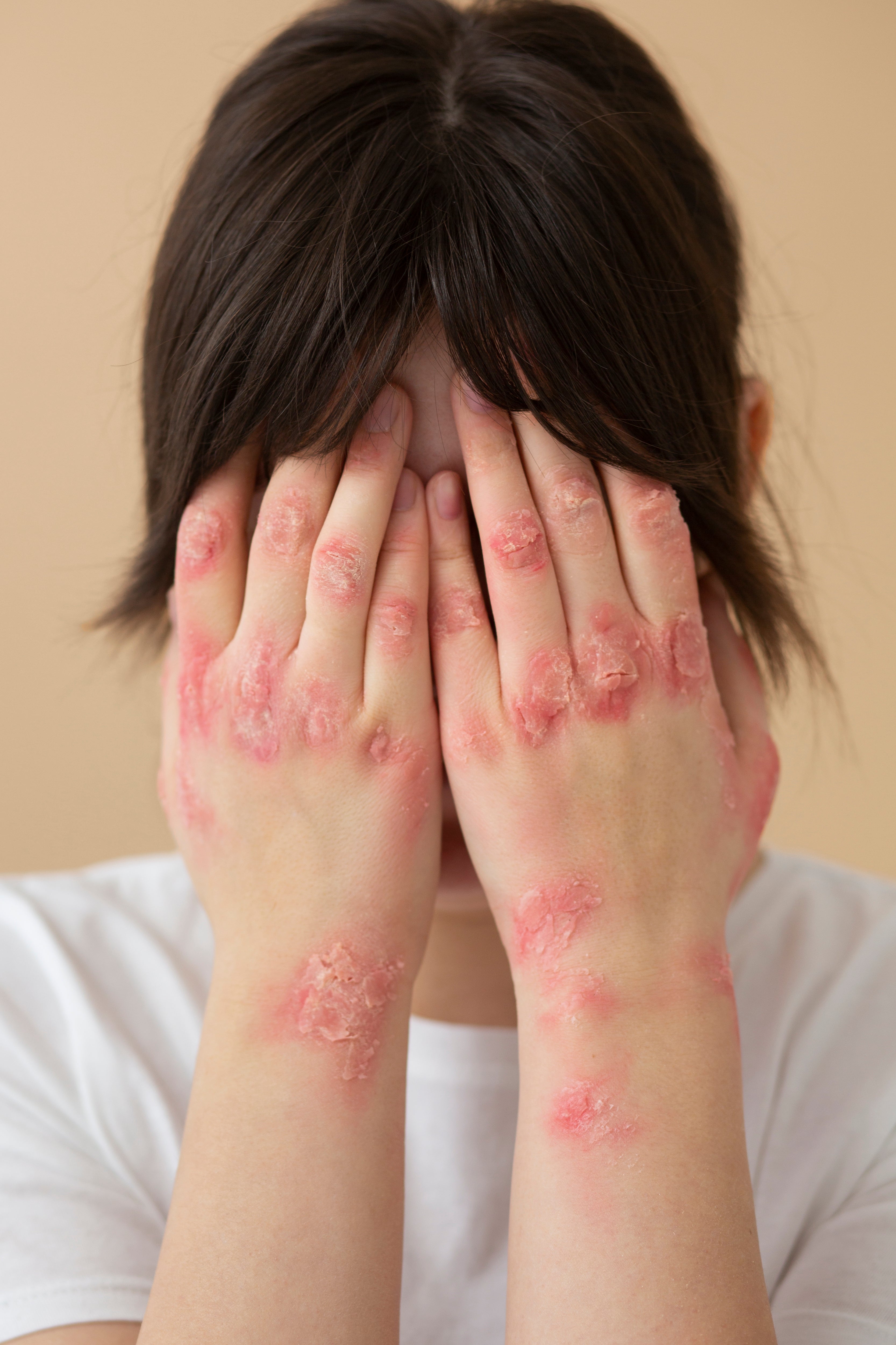 cannabis for psoriasis