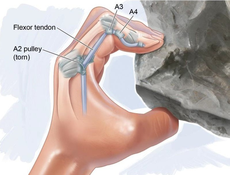 Climbing injury