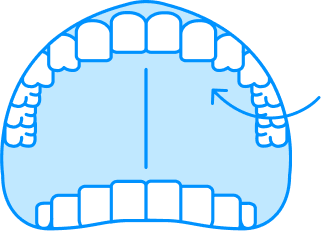 upper-teeth-impression