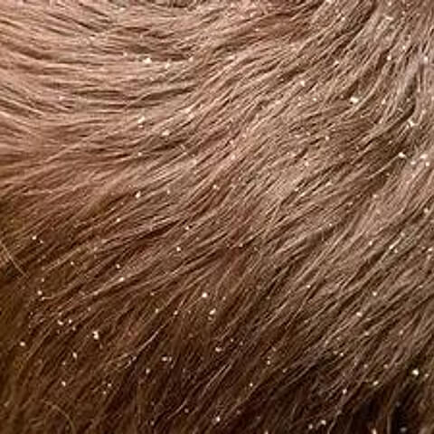 A head of hair with bad dandruff not from a real shampoo bar