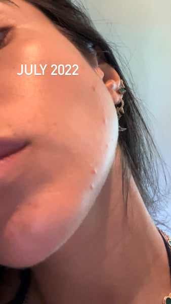 Roxy showing her facial hormonal acne at in July 2022.