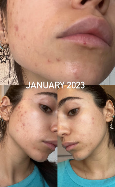 More changes to Roxy's hormonal acne through January 2023