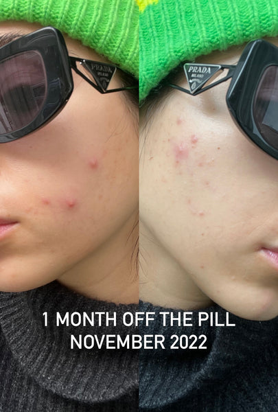 Roxy showing her face and changes in hormonal acne after one month off of the pill