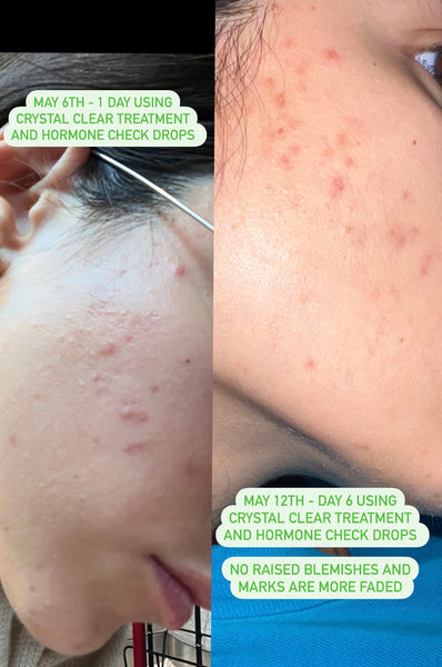 Roxy showing the effects of the crystal clear treatment as her acne starts to fade throughout May