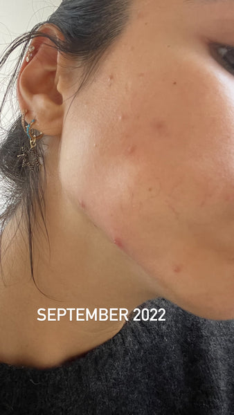 Roxy showing her hormonal acne in Septemeber 2022