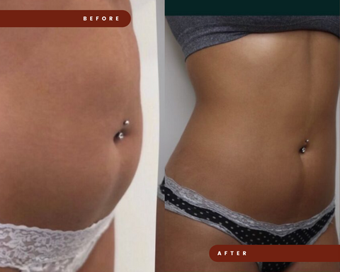 Before and after images showcasing the results of truSculpt fat reduction treatment at Mel Hornery Cosmetics, highlighting the significant reduction in body fat.