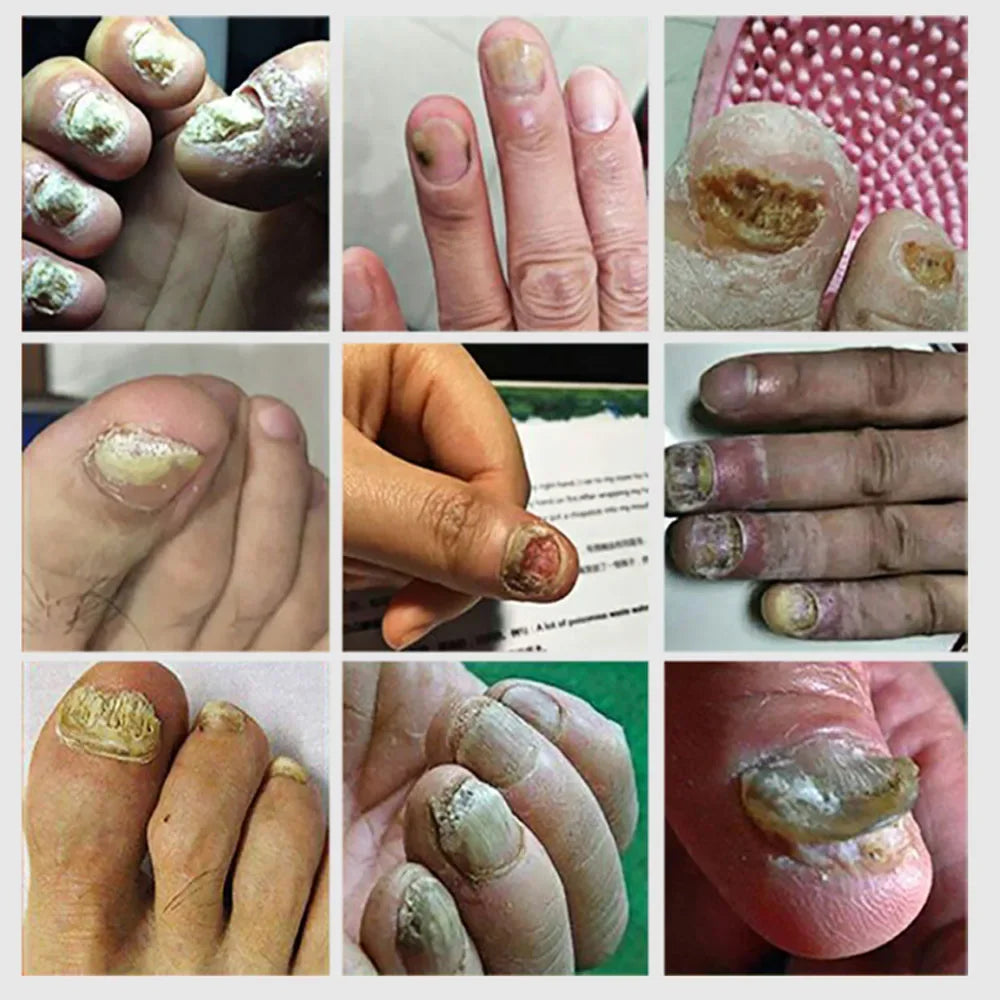 Nail Fungus Defender Serum - Image 5