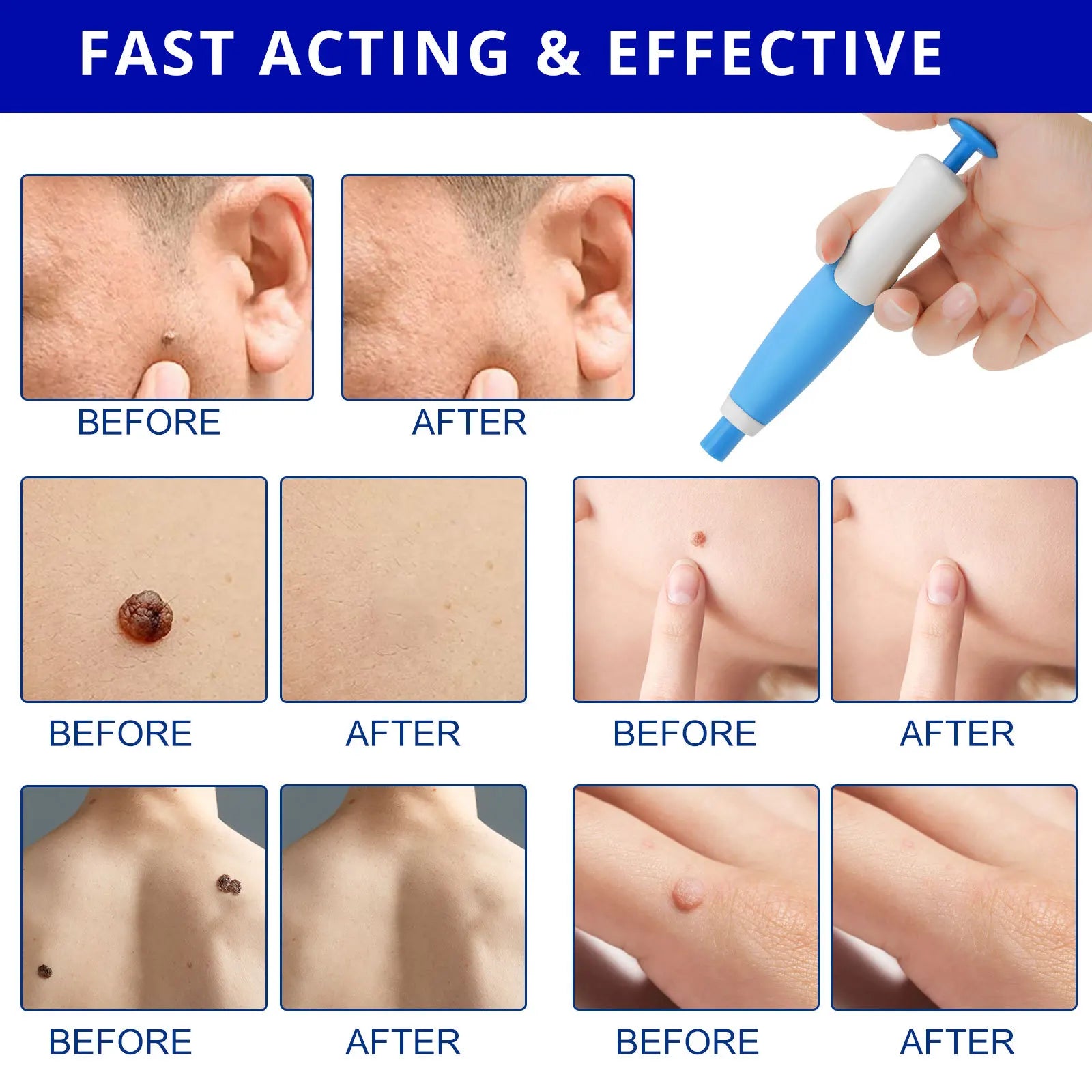 Skin Tag Removal Kit - Image 9