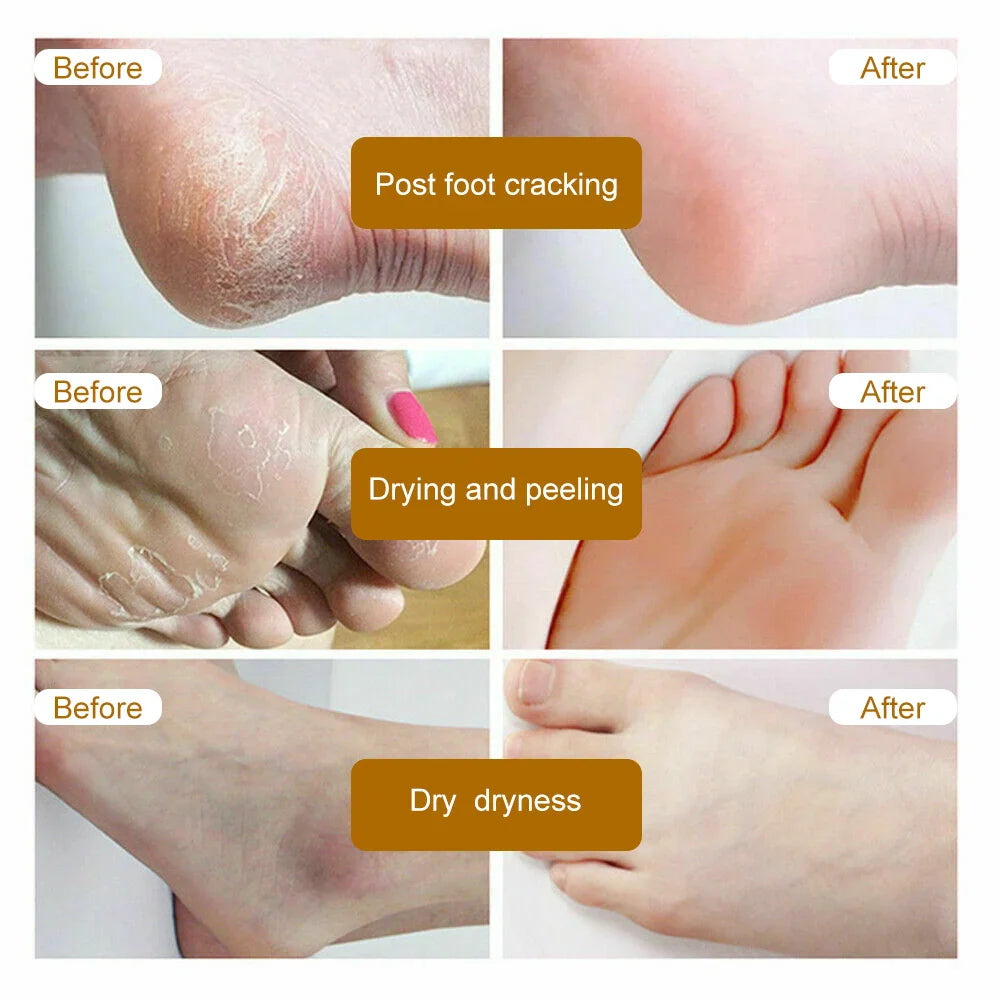 Dead Skin Remover Crack Cream - Image 12