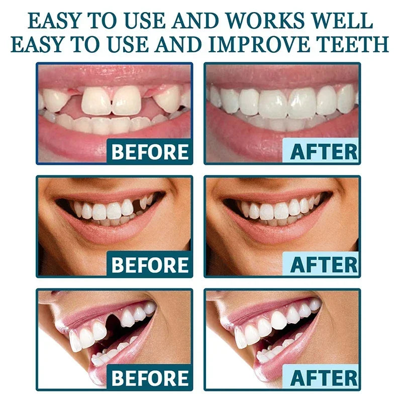 Adjustable Snap-On Dentures - Image 4