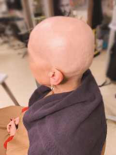 Alopecia woman BYSIX