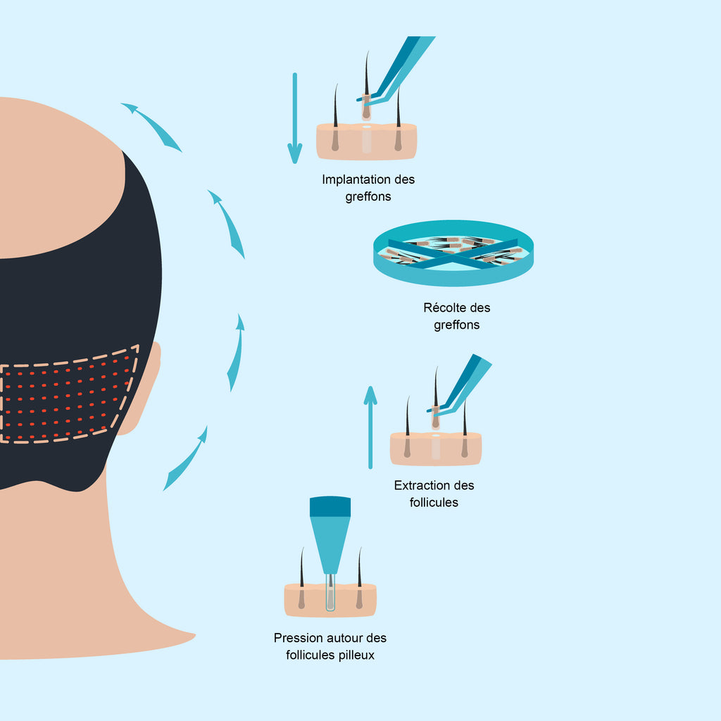 Hair implant FUE method