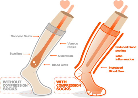 Understanding compression sock levels.