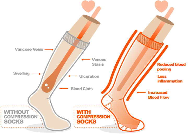 Diagram of how compression socks work on your legs.