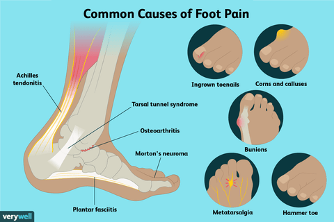 illustration of a foot and it's common problems