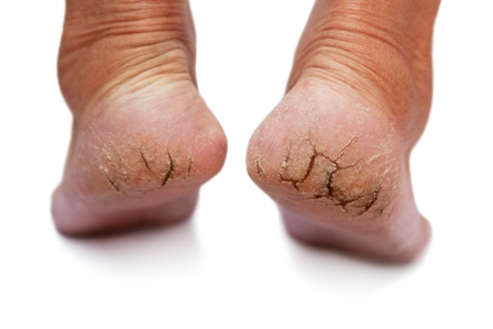 Dealing with Heel Fissures - Almawi Limited The Holistic Clinic