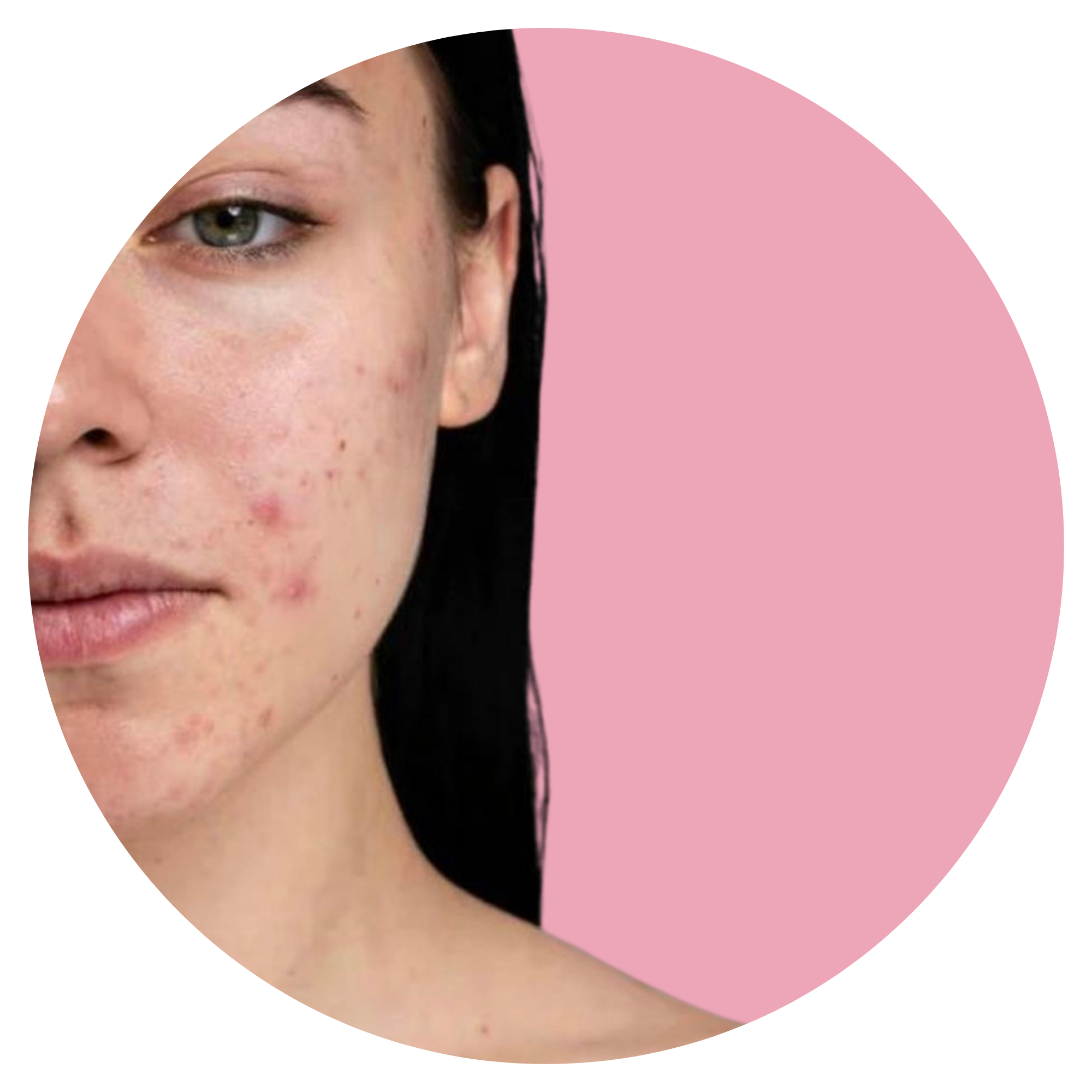 Korean skincare for acne/pimple