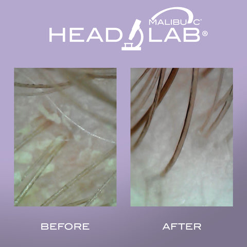 SCALP TREATMENT BEFORE AND AFTER